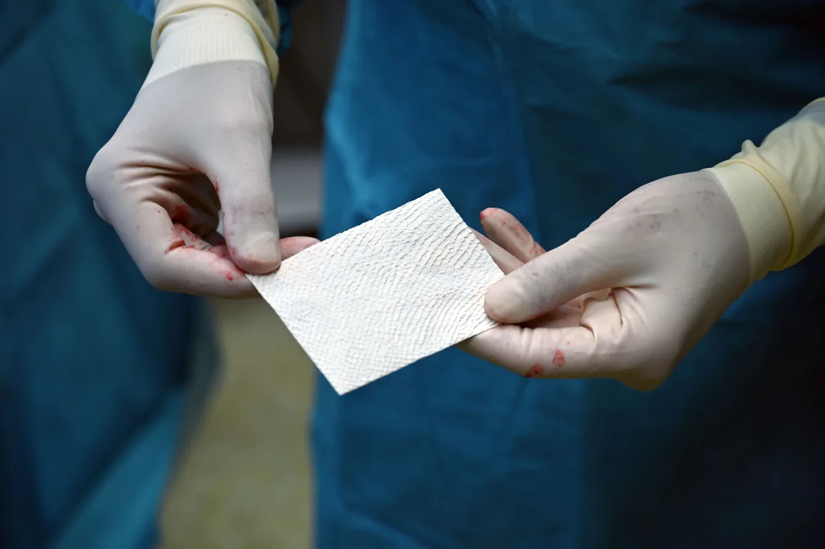 Die Fischhaut sieht aus wie ein Stück Löschpapier. Ein Stück der Fischhaut, gehalten von einem Chirurgen